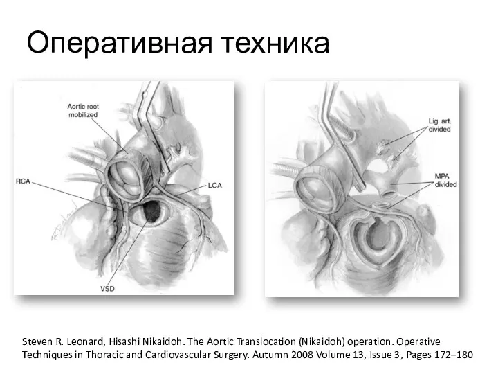 Оперативная техника Steven R. Leonard, Hisashi Nikaidoh. The Aortic Translocation