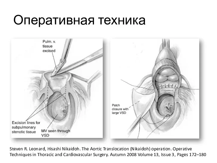 Оперативная техника Steven R. Leonard, Hisashi Nikaidoh. The Aortic Translocation