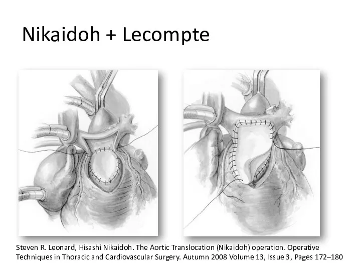 Nikaidoh + Lecompte Steven R. Leonard, Hisashi Nikaidoh. The Aortic