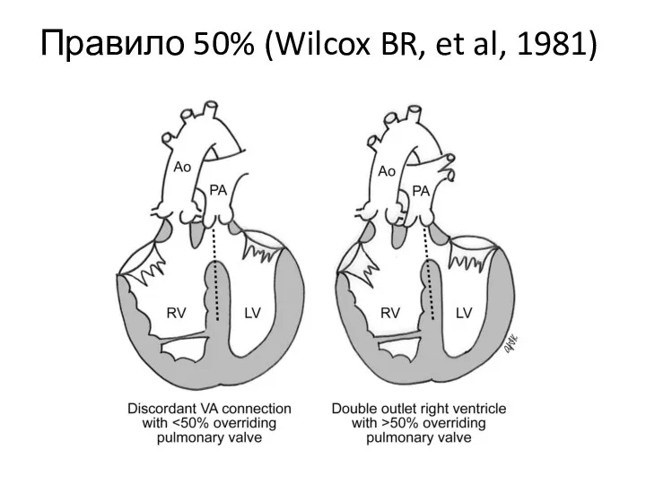 Правило 50% (Wilcox BR, et al, 1981)