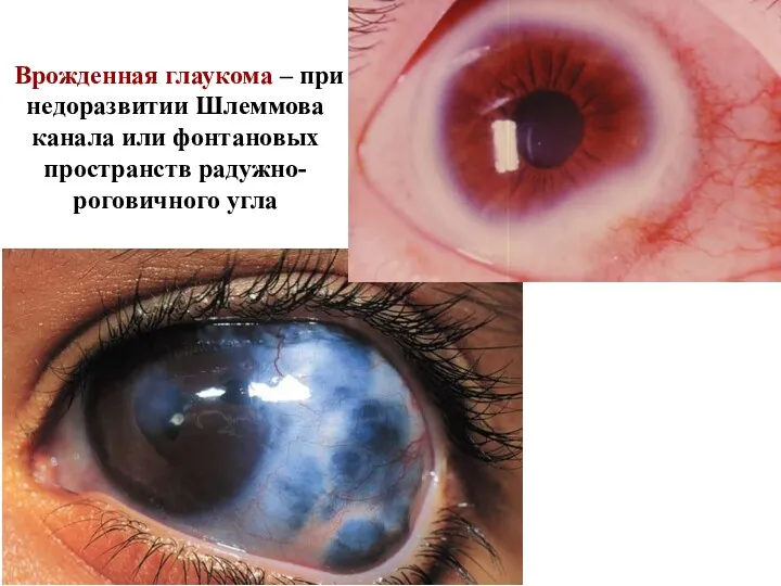Врожденная глаукома – при недоразвитии Шлеммова канала или фонтановых пространств радужно-роговичного угла