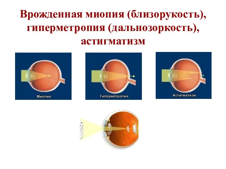 Врожденная миопия (близорукость), гиперметропия (дальнозоркость), астигматизм