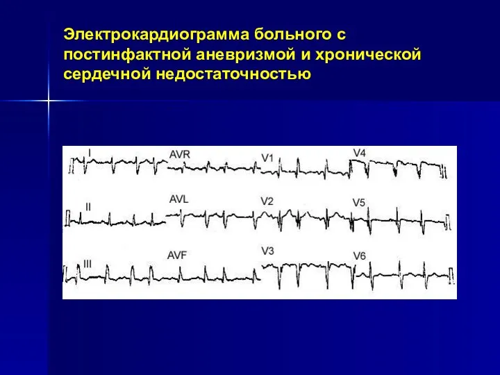 Электрокардиограмма больного с постинфактной аневризмой и хронической сердечной недостаточностью