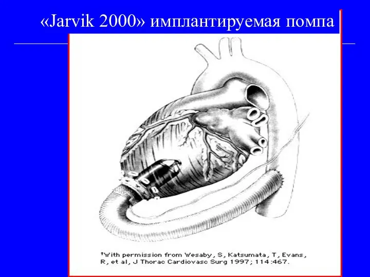 «Jarvik 2000» имплантируемая помпа