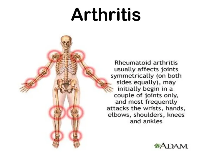 Arthritis