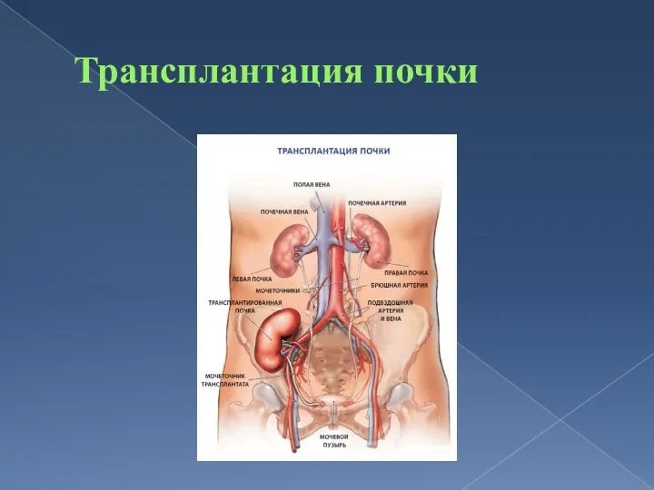 Трансплантация почки