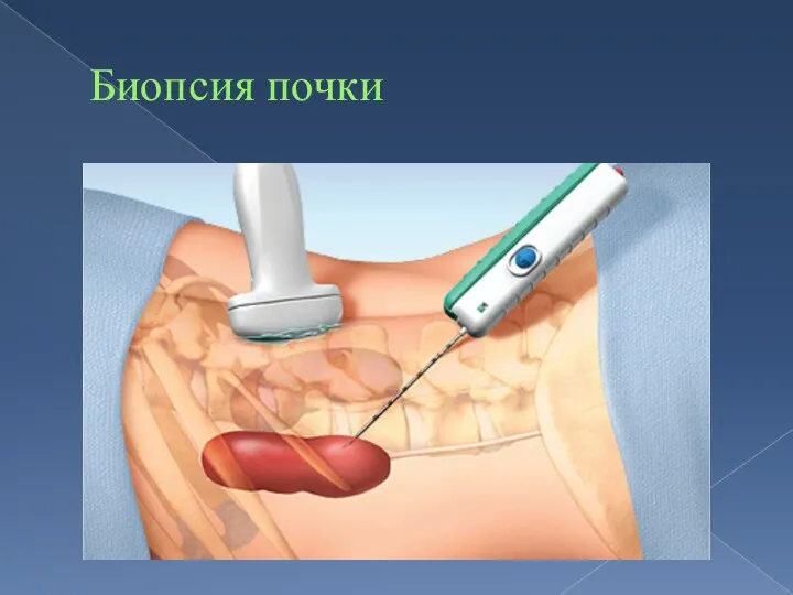 Биопсия почки