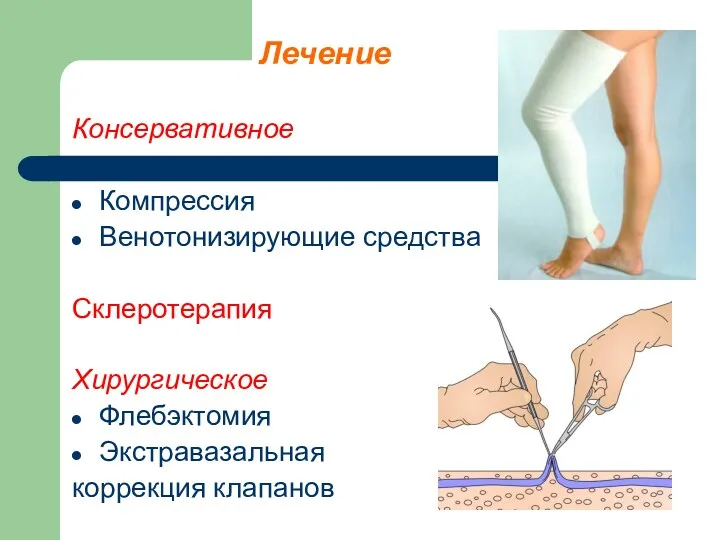 Лечение Консервативное Компрессия Венотонизирующие средства Склеротерапия Хирургическое Флебэктомия Экстравазальная коррекция клапанов