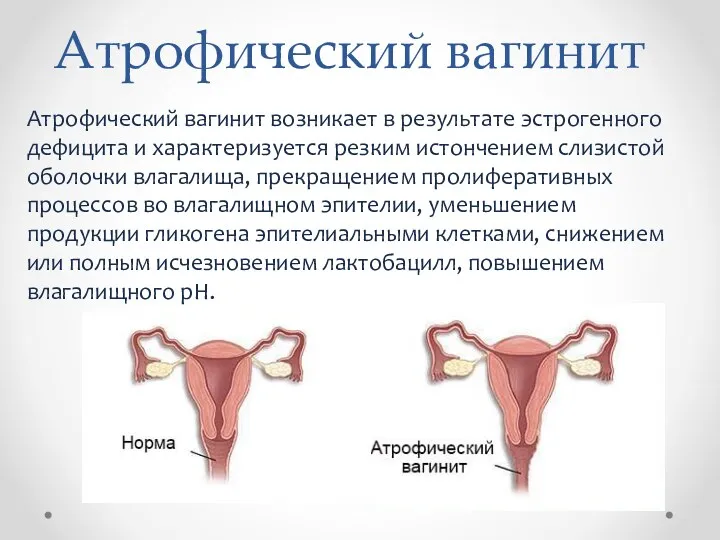 Атрофический вагинит Атрофический вагинит возникает в результате эстрогенного дефицита и