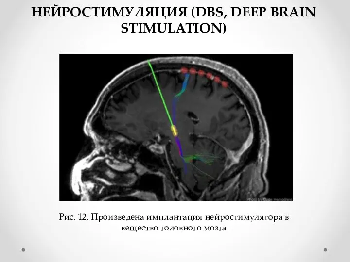 НЕЙРОСТИМУЛЯЦИЯ (DBS, DEEP BRAIN STIMULATION) Рис. 12. Произведена имплантация нейростимулятора в вещество головного мозга