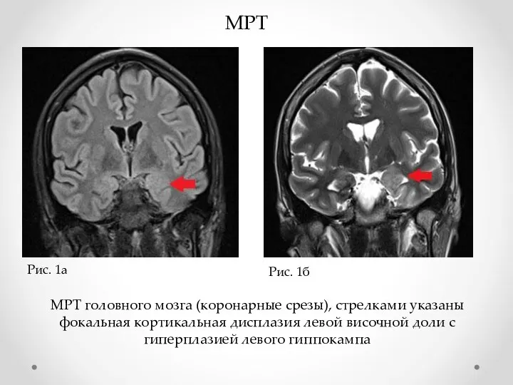 МРТ Рис. 1а Рис. 1б МРТ головного мозга (коронарные срезы),