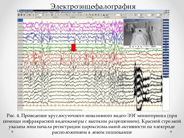 Электроэнцефалография Рис. 4. Проведение круглосуточного инвазивного видео-ЭЭГ мониторинга (при помощи