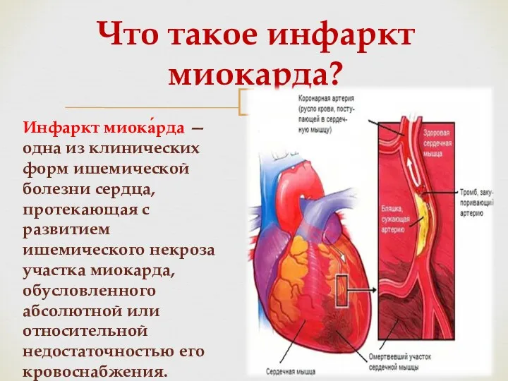 Инфаркт миока́рда — одна из клинических форм ишемической болезни сердца,