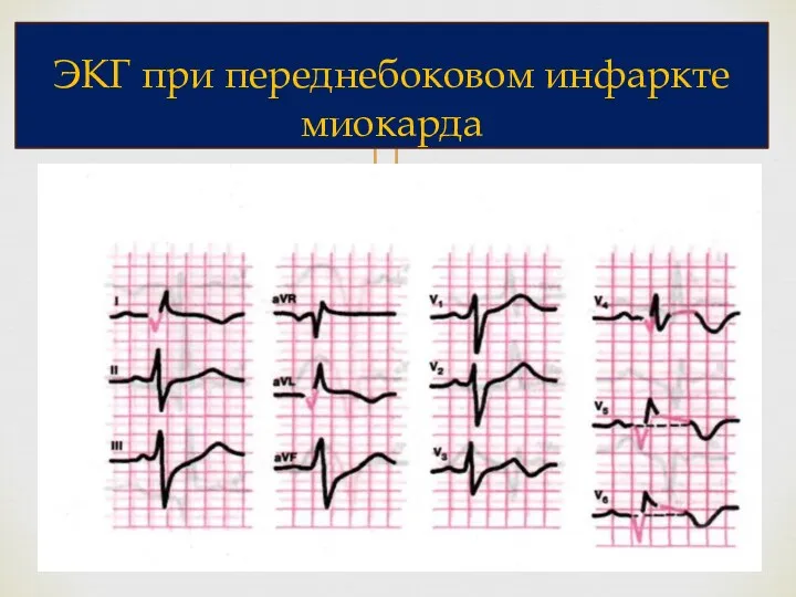 ЭКГ при переднебоковом инфаркте миокарда