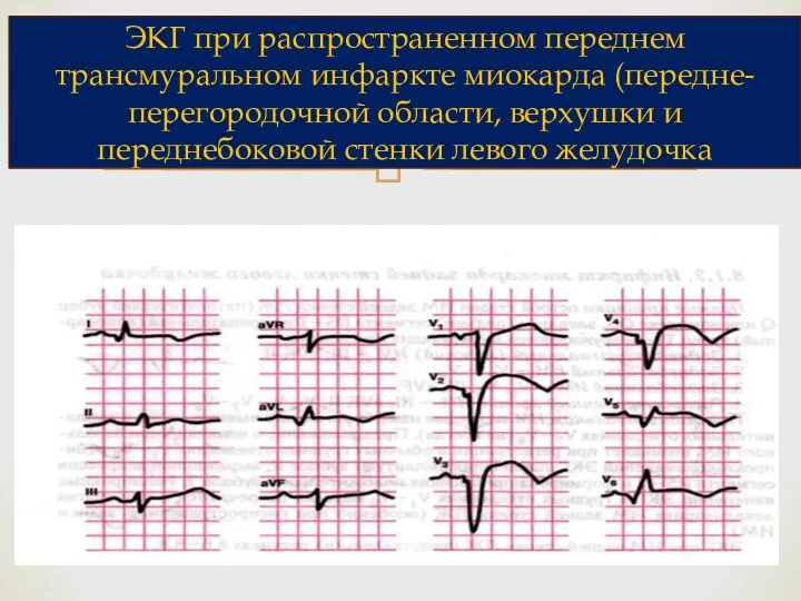 ЭКГ при распространенном переднем трансмуральном инфаркте миокарда (передне-перегородочной области, верхушки и переднебоковой стенки левого желудочка