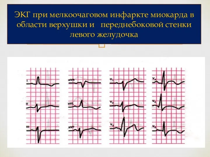ЭКГ при мелкоочаговом инфаркте миокарда в области верхушки и переднебоковой стенки левого желудочка