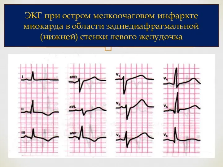 ЭКГ при остром мелкоочаговом инфаркте миокарда в области заднедиафрагмальной (нижней) стенки левого желудочка