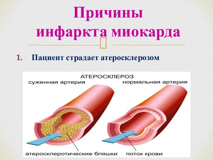 Пациент страдает атеросклерозом Причины инфаркта миокарда