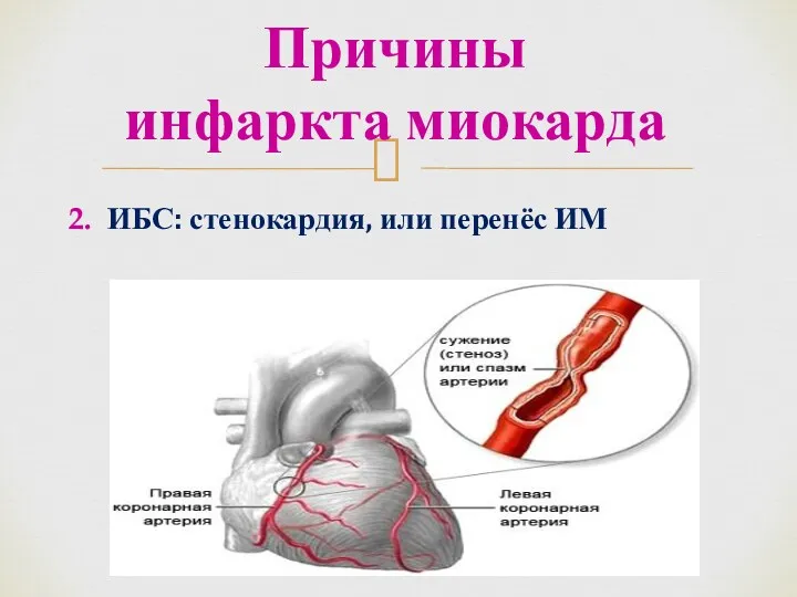 2. ИБС: стенокардия, или перенёс ИМ Причины инфаркта миокарда