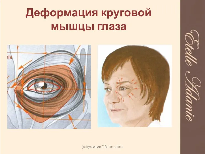 Деформация круговой мышцы глаза (с) Кузнецов Г.В. 2013-2014