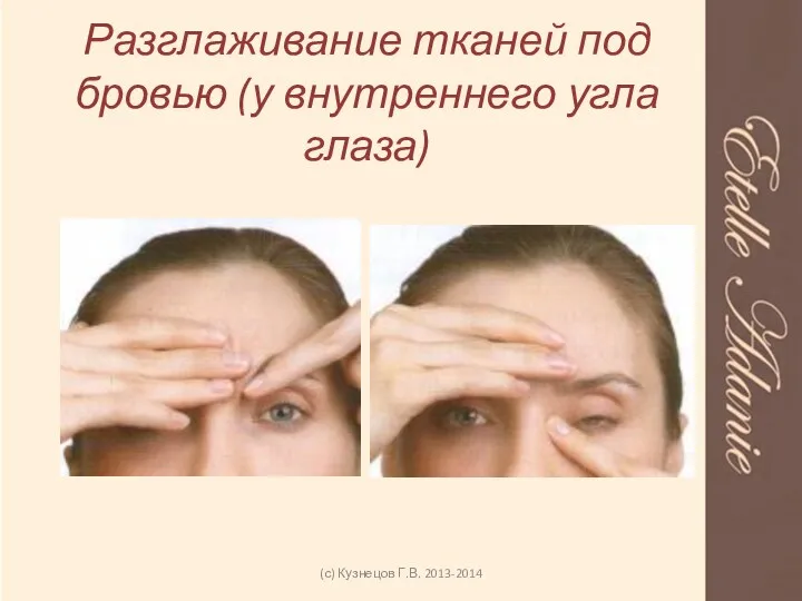 Разглаживание тканей под бровью (у внутреннего угла глаза) (с) Кузнецов Г.В. 2013-2014