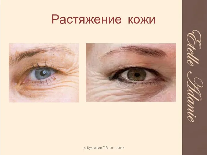 Растяжение кожи (с) Кузнецов Г.В. 2013-2014