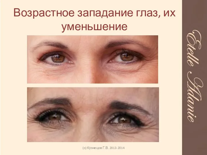 Возрастное западание глаз, их уменьшение (с) Кузнецов Г.В. 2013-2014