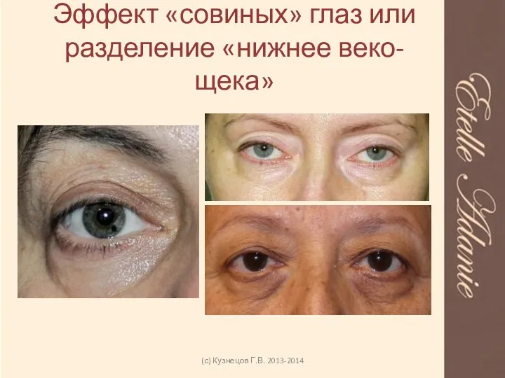 Эффект «совиных» глаз или разделение «нижнее веко-щека» (с) Кузнецов Г.В. 2013-2014
