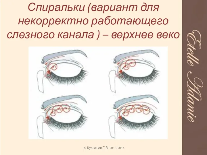 Спиральки (вариант для некорректно работающего слезного канала ) – верхнее веко (с) Кузнецов Г.В. 2013-2014