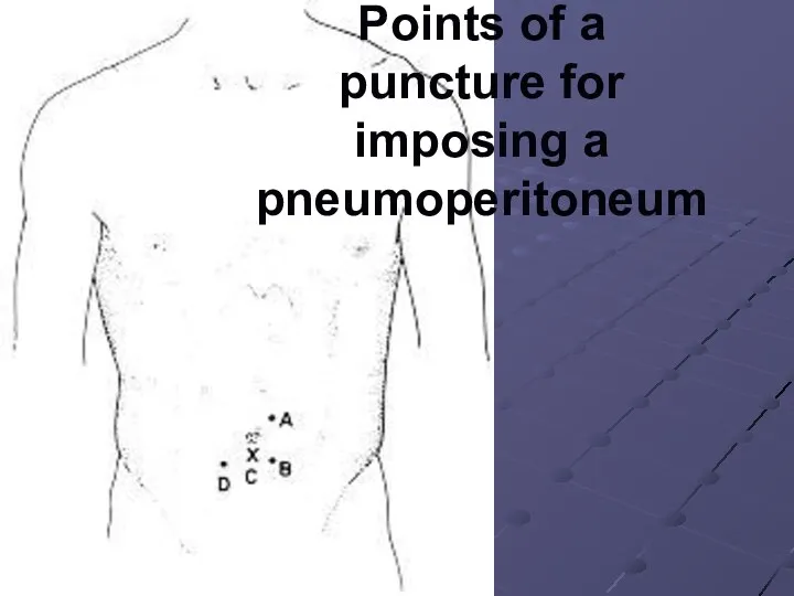 Points of a puncture for imposing a pneumoperitoneum