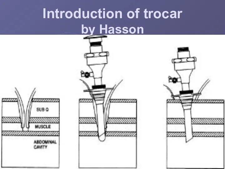 Introduction of trocar by Hasson