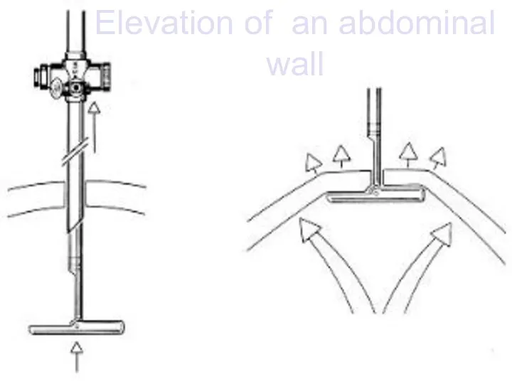 Elevation of an abdominal wall