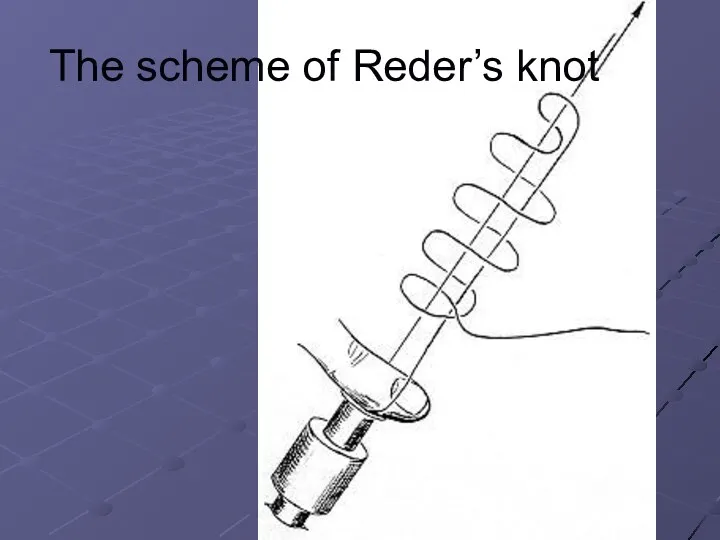 The scheme of Reder’s knot