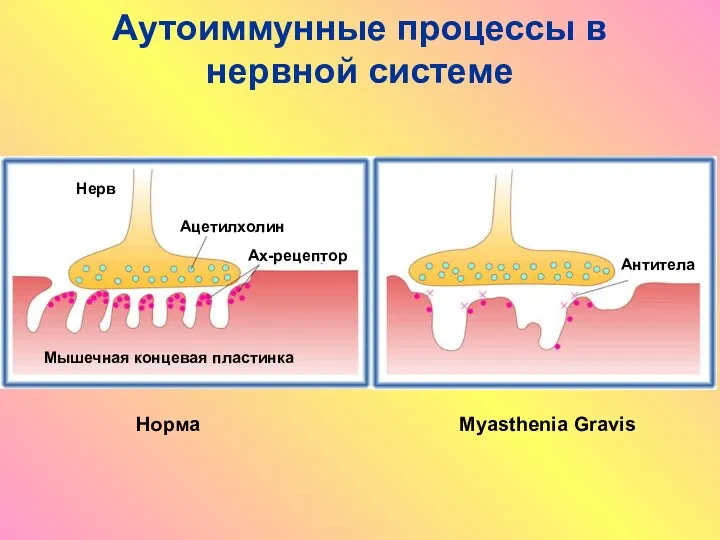 Аутоиммунные процессы в нервной системе Ацетилхолин Ах-рецептор Мышечная концевая пластинка Антитела Нерв Норма Myasthenia Gravis