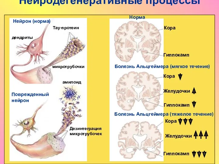Нейродегенеративные процессы Нейрон (норма) дендриты микротрубочки Тау-протеин Дезинтеграция микротрубочек амилоид