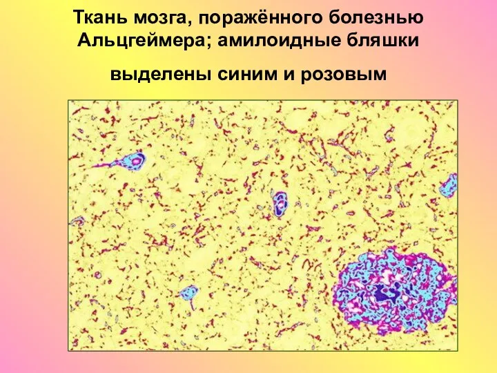 Ткань мозга, поражённого болезнью Альцгеймера; амилоидные бляшки выделены синим и розовым