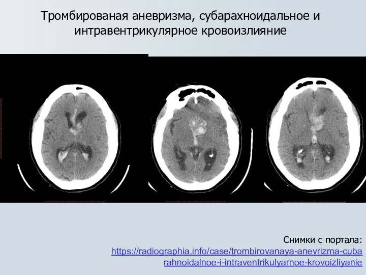 Тромбированая аневризма, субарахноидальное и интравентрикулярное кровоизлияние Снимки с портала: https://radiographia.info/case/trombirovanaya-anevrizma-cubarahnoidalnoe-i-intraventrikulyarnoe-krovoizliyanie