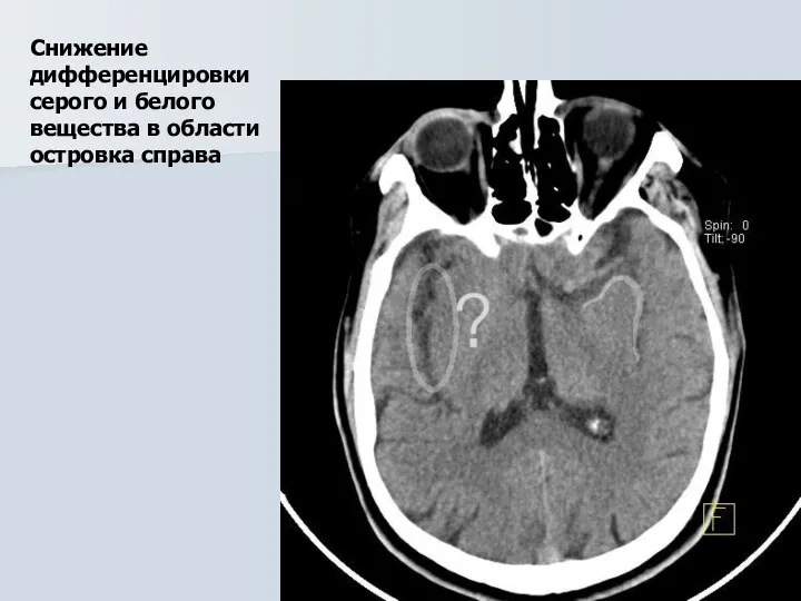 Снижение дифференцировки серого и белого вещества в области островка справа