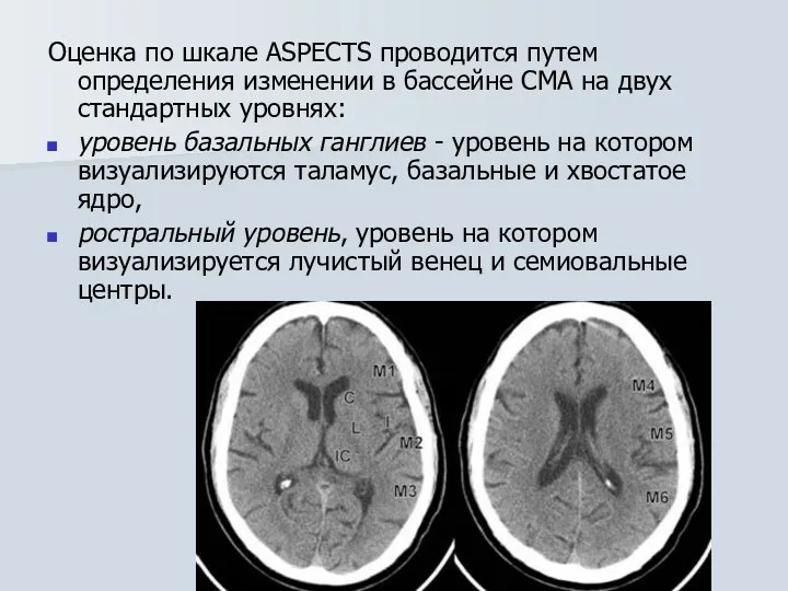 Оценка по шкале ASPECTS проводится путем определения изменении в бассейне