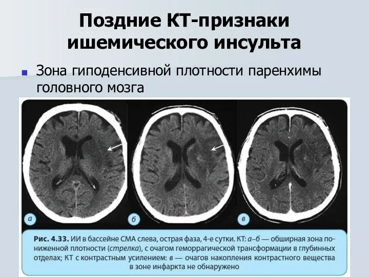 Поздние КТ-признаки ишемического инсульта Зона гиподенсивной плотности паренхимы головного мозга