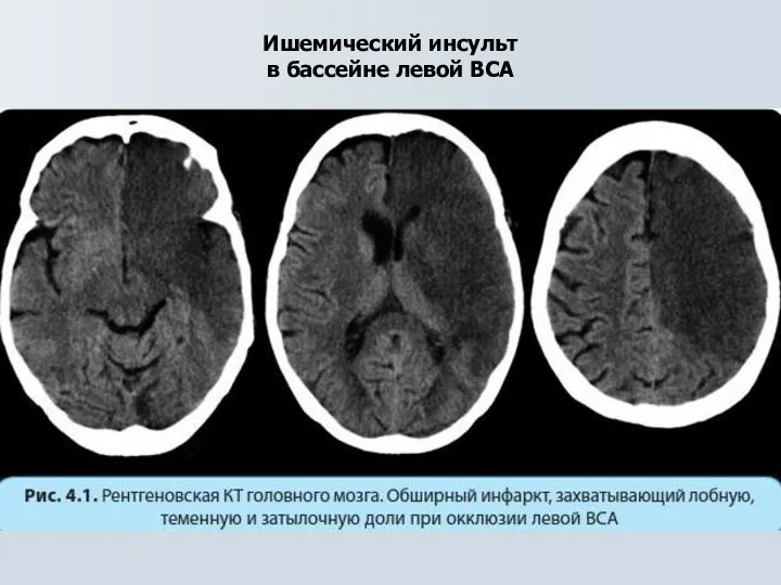 Ишемический инсульт в бассейне левой ВСА