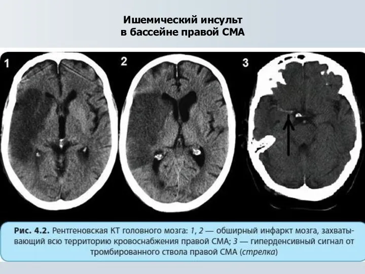 Ишемический инсульт в бассейне правой СМА