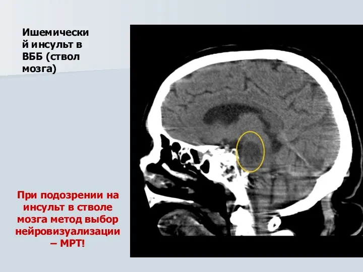 Ишемический инсульт в ВББ (ствол мозга) При подозрении на инсульт