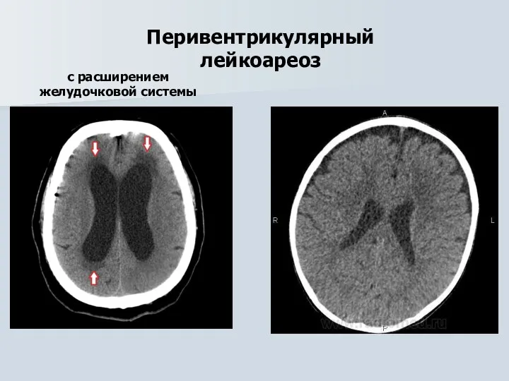 Перивентрикулярный лейкоареоз с расширением желудочковой системы