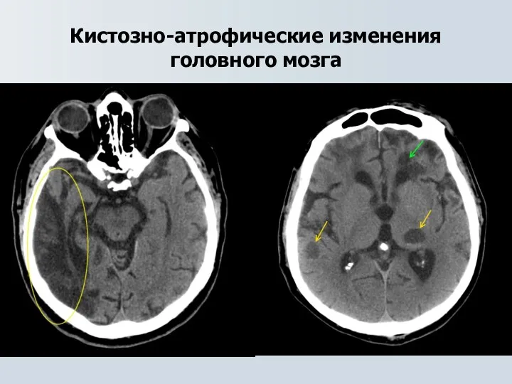 Кистозно-атрофические изменения головного мозга