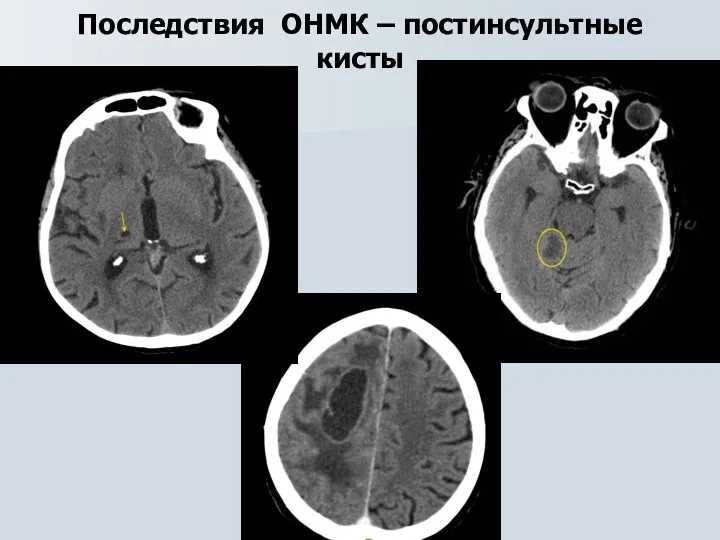 Последствия ОНМК – постинсультные кисты