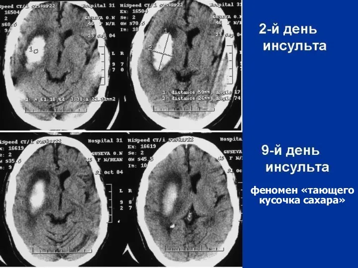 феномен «тающего кусочка сахара» феномен «тающего кусочка сахара»