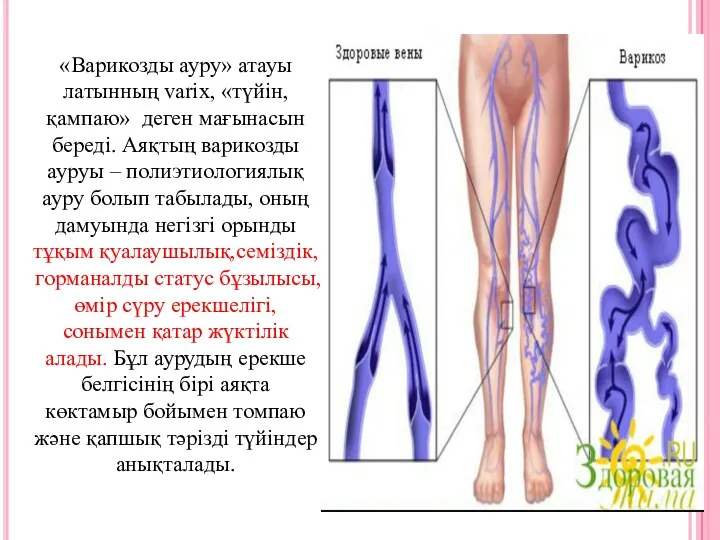 «Варикозды ауру» атауы латынның varix, «түйін, қампаю» деген мағынасын береді.