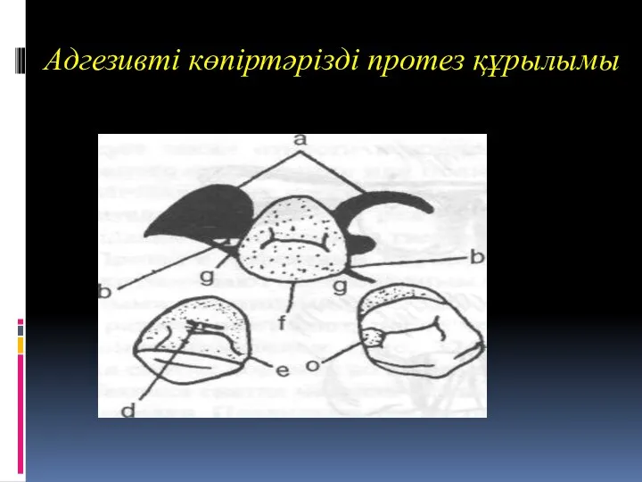 Адгезивті көпіртәрізді протез құрылымы