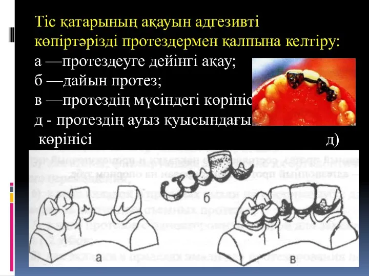 Тіс қатарының ақауын адгезивті көпіртәрізді протездермен қалпына келтіру: а —протездеуге